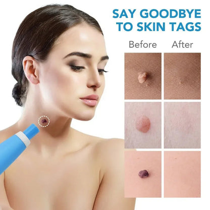 TagErase™ Skin Tag Remover Kit